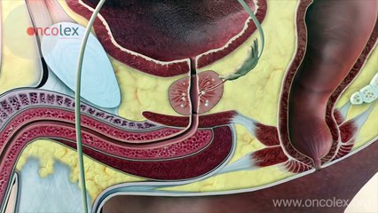 trieu chung ung thu am dao