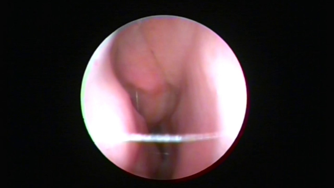 Doğru Yöntemle Sinüzit tedavisi ve Sinüzit Ameliyatı