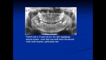 A Rare Case More Than One Tooth Block the Second Molar Tooth Eruption