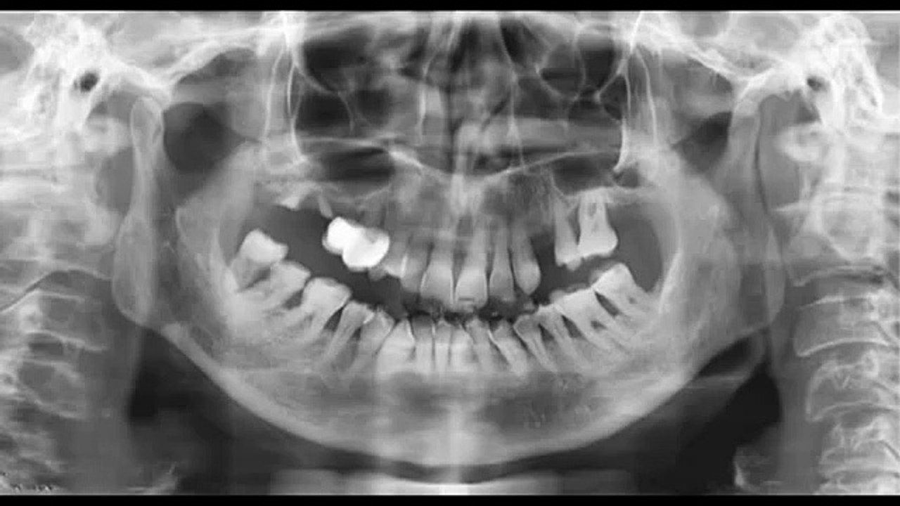 Alveolar Crest Unswitching Surgery
