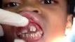 Un dentiste retire des larves des gencives d'une petite fille