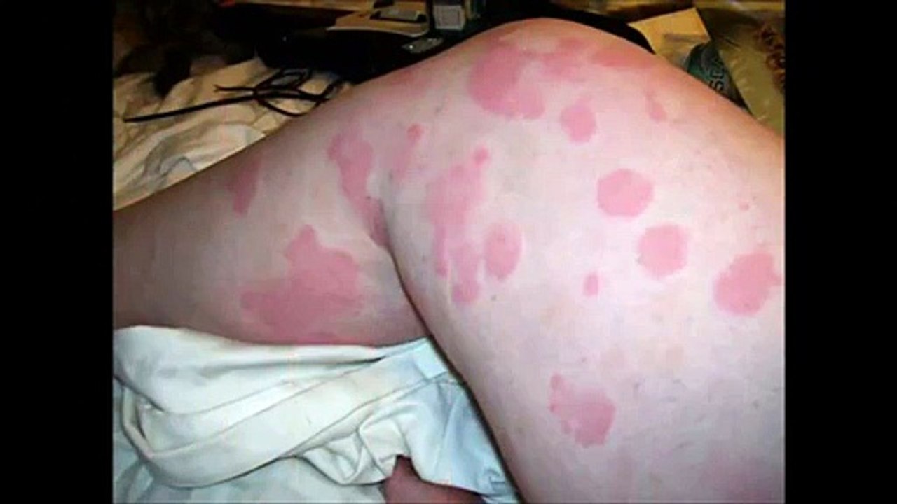 urticaria treatment home remedies for hives - h...