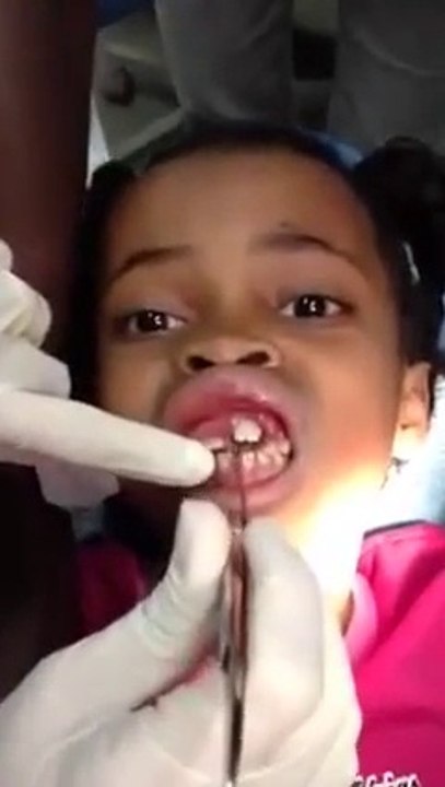 Une fillette a les gencives infestées de larves