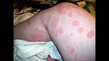 Guide to Get Rid Of Hives - Urticaria Hives Treatment - New Reviews