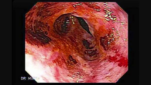 Gastritis -Causas y Remedios Para la Gastritis [Descargar PDF Adios Intestino Irritable]