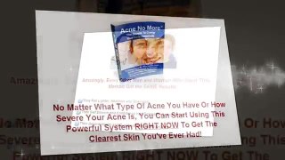 How To Get Rid Of Acne Naturally and Fast - Acne no more Review