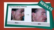 Acne No More Review And Testimonials (Acne No More Results)