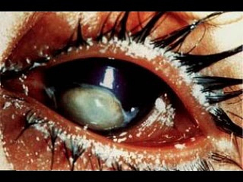 [KRTM]   Blindnetz