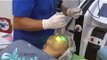 Tratamiento de la Rosacea con el Laser Cutera XEO DR LUIS EDUARDO MARTINEZ   CLINILASER