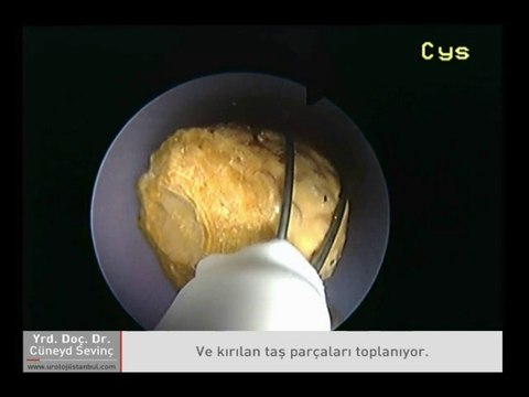 Koraliform Böbrek Taşlarında Perkütan NefroLitotomi (PNL) - Op. Dr. Cüneyd Sevinç