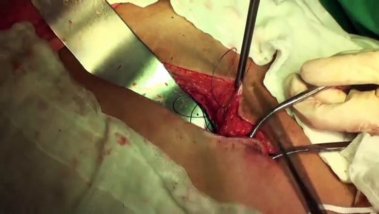 Đóng bụng Abdominal closing