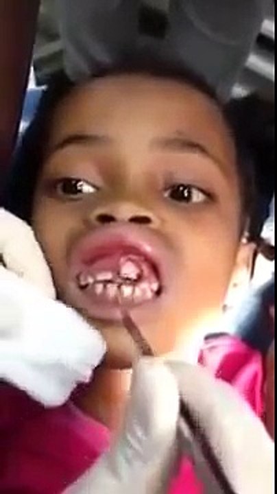 Dentists Removes Maggots From Little Girl's Gums