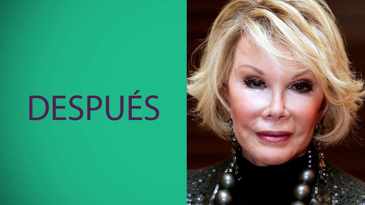 RANDOM: Malas cirugías plásticas de famosos