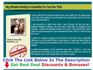 Keratosis Pilaris Treatment Aspirin + Must Watch!!