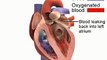 Heart valve surgery - operation for replacement heart valves