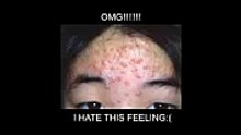 [LADY GAGA] Acne No More Review - Worlds Biggest Pimple