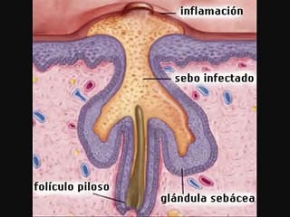 Como Eliminar El Acne - Acne Rosacea - Acne Vulgaris