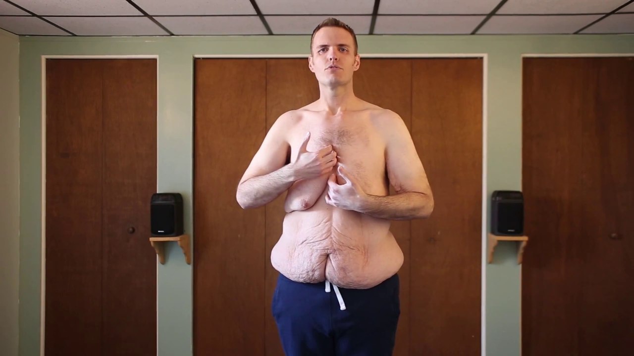 Cette homme a perdu 180kg et a besoin d'une chirurgie pour retirer l'excès de peau