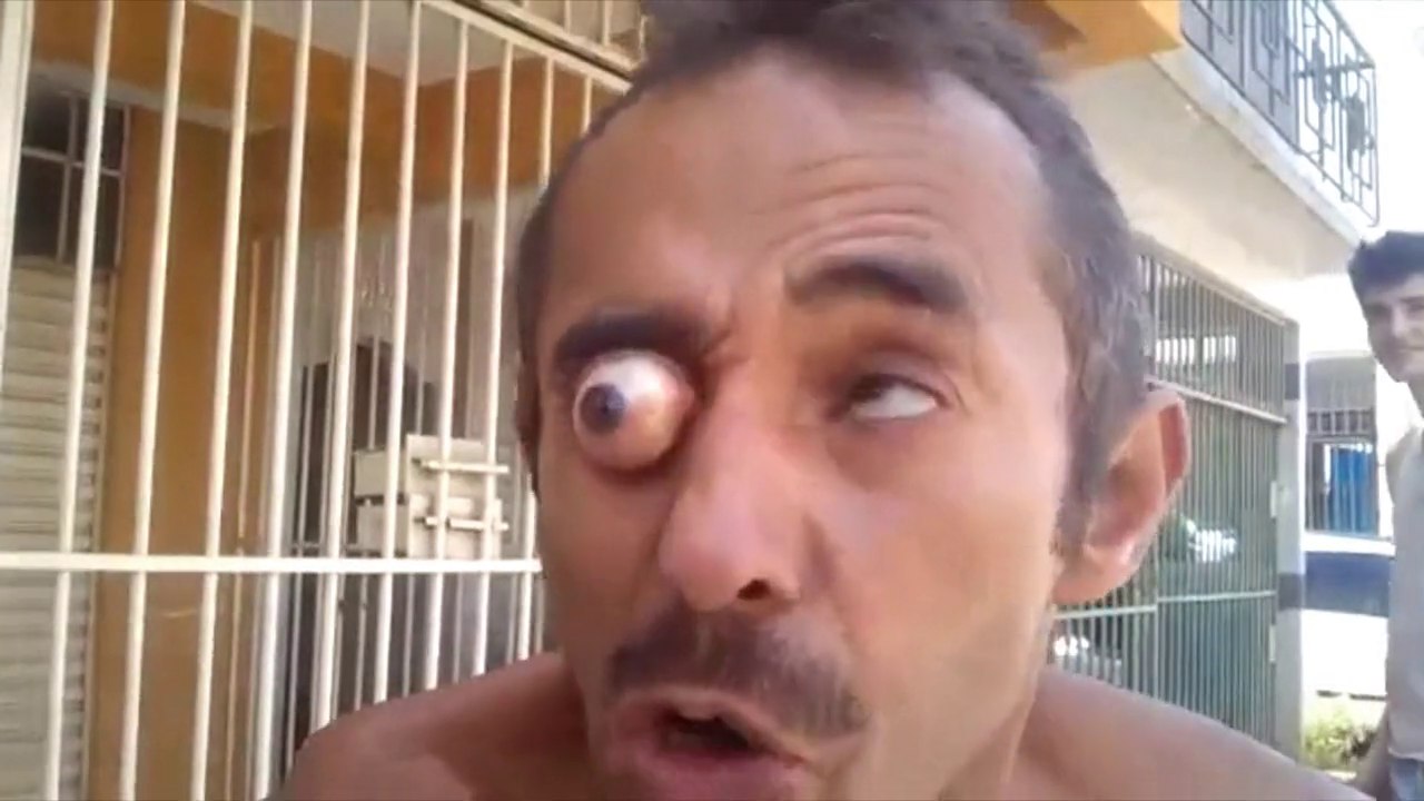 Un homme avec un oeil exorbité