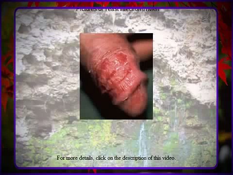 Male Yeast Infection Need internal And External Treatment