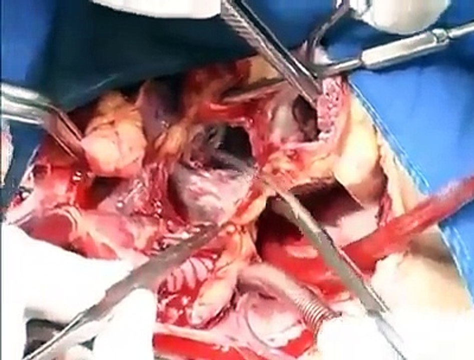Heart change operation