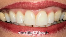 Dental Bonding - Bismarck, ND - Dr. Everett Heringer