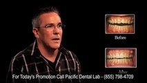 Pacific Dental Lab  Veneers Before and After Thousand Oaks CA 91360