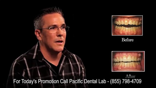 Pacific Dental Lab Veneers Before and After Thousand Oaks CA 91360