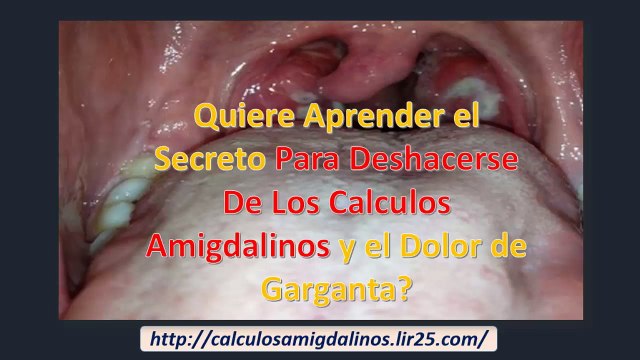 Sufriendo Por el Mal Aliento Usted Puede Tener Calculos Amigdalinos