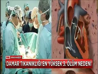 Damar tıkanıklığı 'Emboli' en yüksek 3. ölüm nedeni Hareketsiz ve şişmanlar risk altında