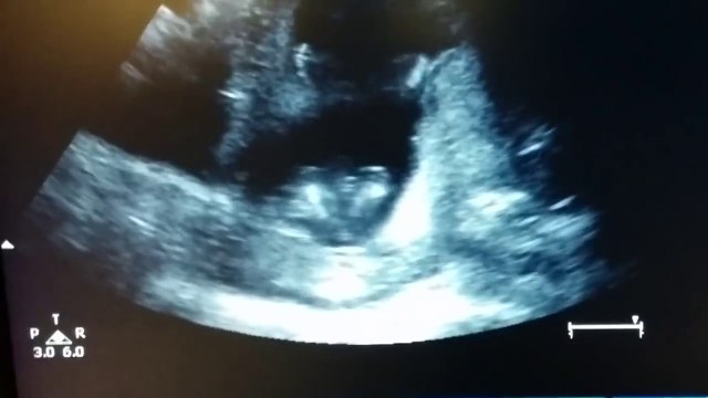 Ultrasound Shows Unborn Baby Clapping Hands In The Womb