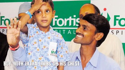 5 People With Extra Body Parts