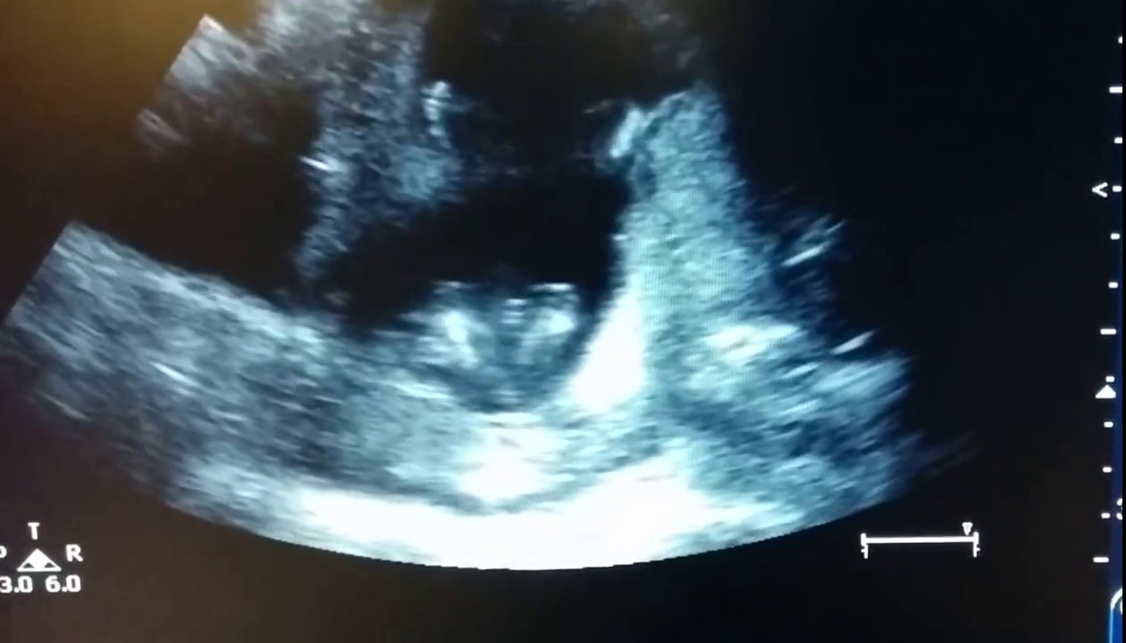 A fetus of 14 weeks applauds during an ultrasound