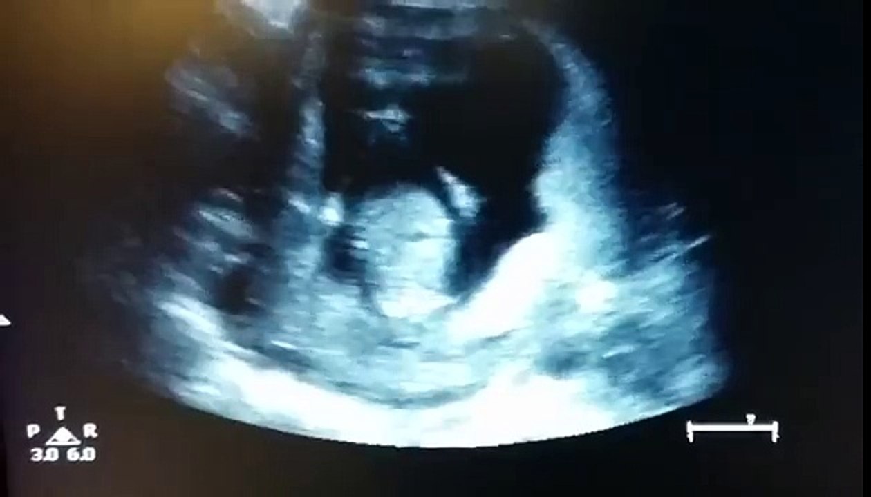 Feto De 3 Meses Aplaude Durante Ecografia Video Dailymotion