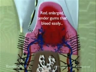 Periodontal Disease 3D animation