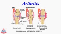 Arthritis/ Repair of Broken Bones / Muscles