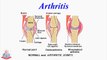 Arthritis/ Repair of Broken Bones / Muscles