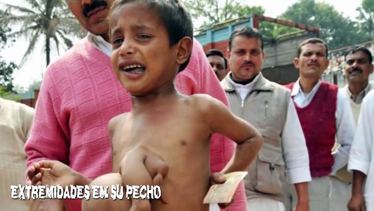 5 Personas Con Deformidades Increíbles
