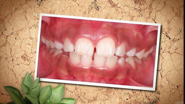 Orthodontist Fort Collins CO - (970) 490-6065