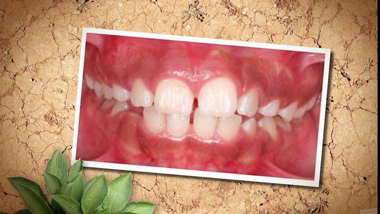 Orthodontist Fort Collins CO - (970) 490-6065