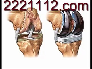 Knee and Hip Replacement -  اردو