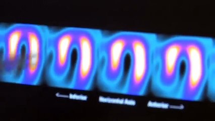 Imagerie médicale et médecine nucléaire : Tout savoir sur la scintigraphie cardiaque