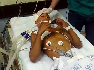 BRAIN DEATH complex spinal reflex