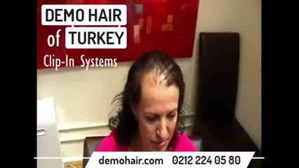 protez saç yaptıranlar, protez saç fiyatları