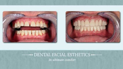 Dental Veneers - Stuart, FL - Palm City, FL - Port St. Lucie, FL