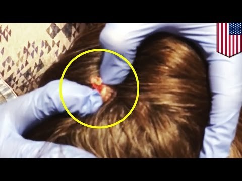 Le moment satisfaisant où vous vous faites enlever un KYSTE SÉBACÉ!