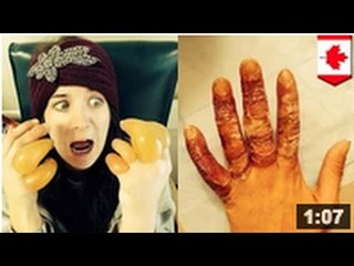 DOIGTS GELÉS: Une australienne éméchée s’endort dans la neige et manque de perdre ses mains