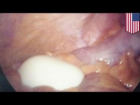 Mężczyzna nie przestaje sikać przez jajko na twardo naciskające na pęcherz