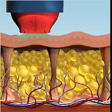 Selülit Tedavisi - Antalya
