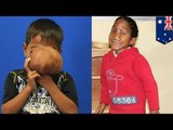 Junge aus Philippinen erholt sich von schwerer Gesichts-OP